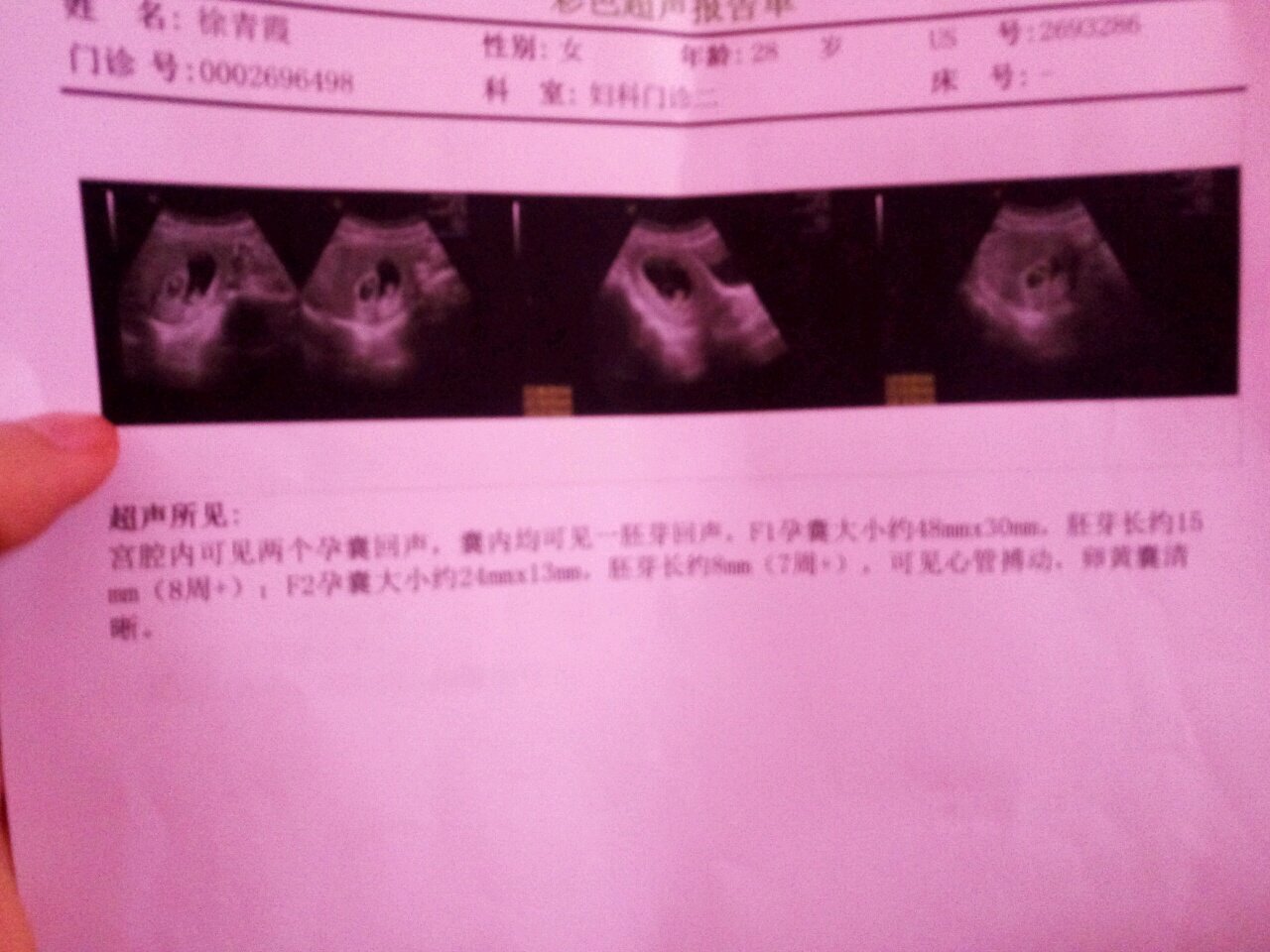 姐妹们单胎转变双胎，太幸运了，一切正常，附图