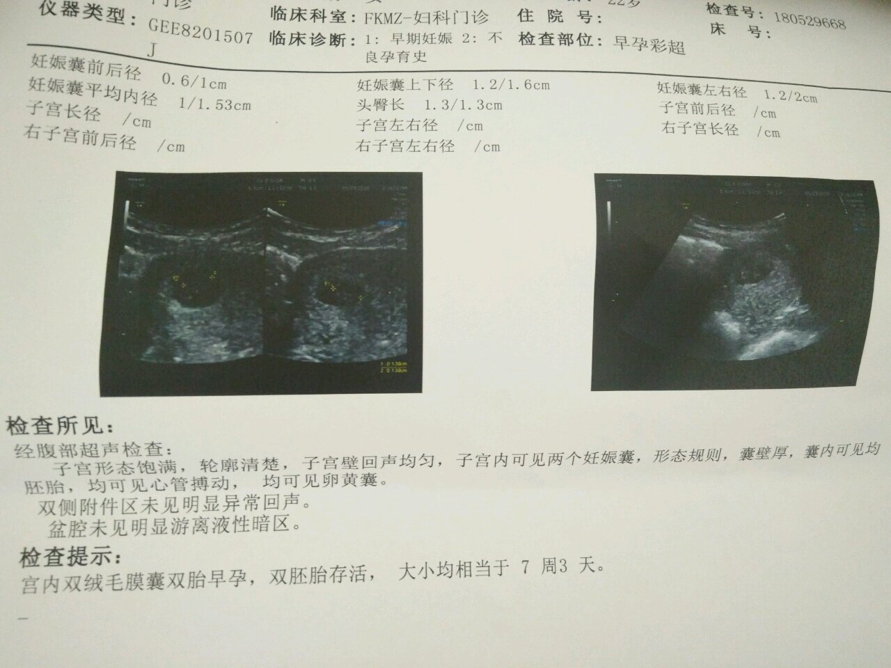 双胞胎健康胎心胎芽！！