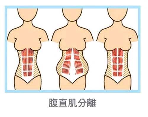 腹直肌分离