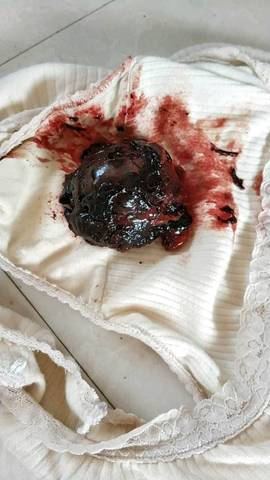 展开问题描述 最佳回答                  是不是宫腔褃面的东西没