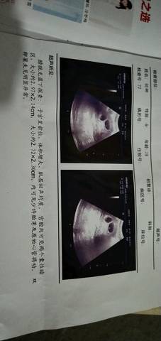 一个孕囊两个胎芽图片