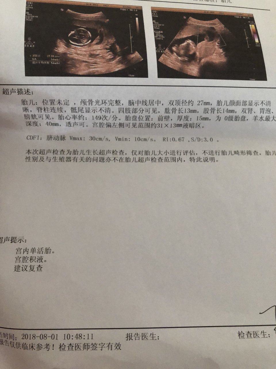 16周流姨妈血 一直有宫腔积液  好担心