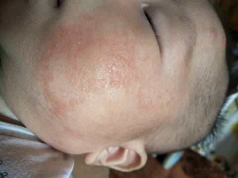 宝宝皮肤有一大堆小红点皮肤很干燥而且还脱皮 这是干燥型湿疹吗 宝宝树