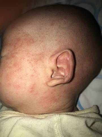婴儿热痱子的症状图片图片
