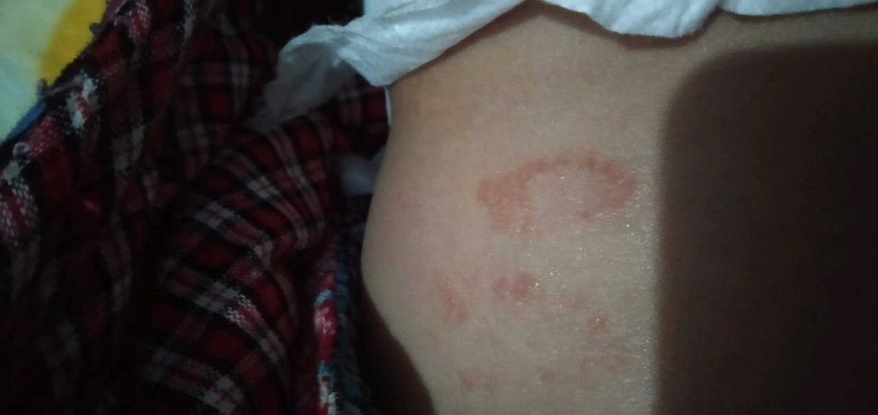 这是疹子吗？？？求解
