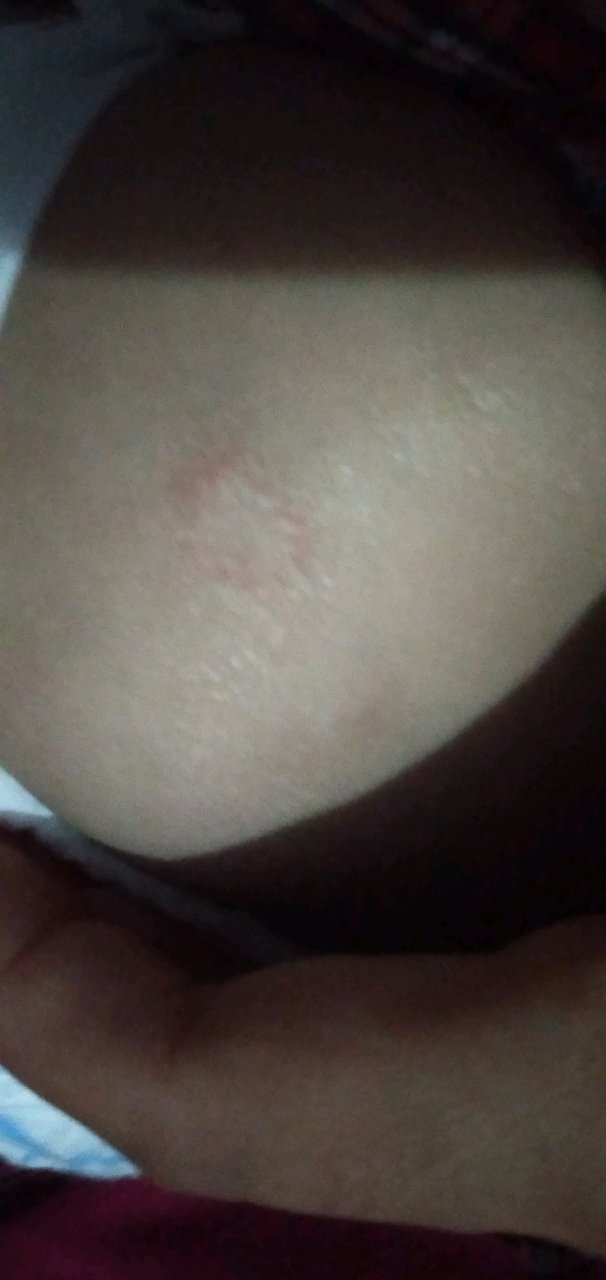 这是疹子吗？？？求解