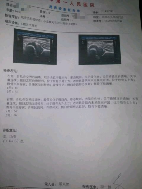 髋关节发育不良