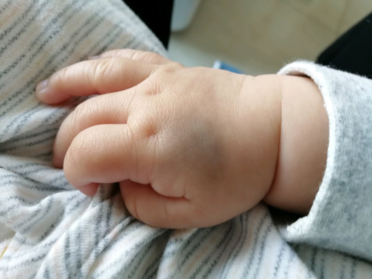 青色胎记什么时候去除合适