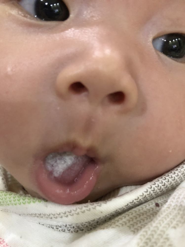 小孩舌苔白