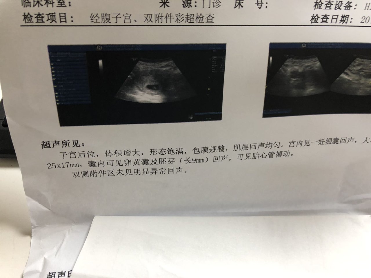 7周有胎心胎芽