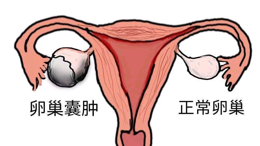 卵巢囊肿分哪些类型？