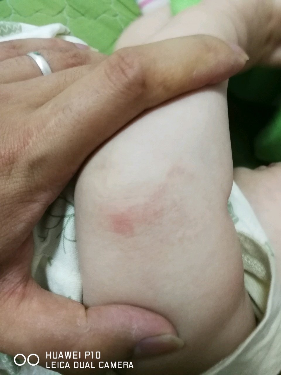 宝宝胳膊肘长了这种东西是什么啊，摸起来表面有点硬