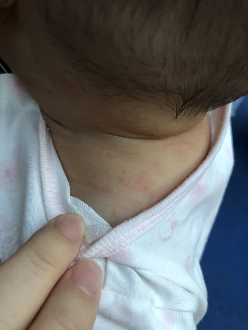 求问这是湿疹还是热疹？