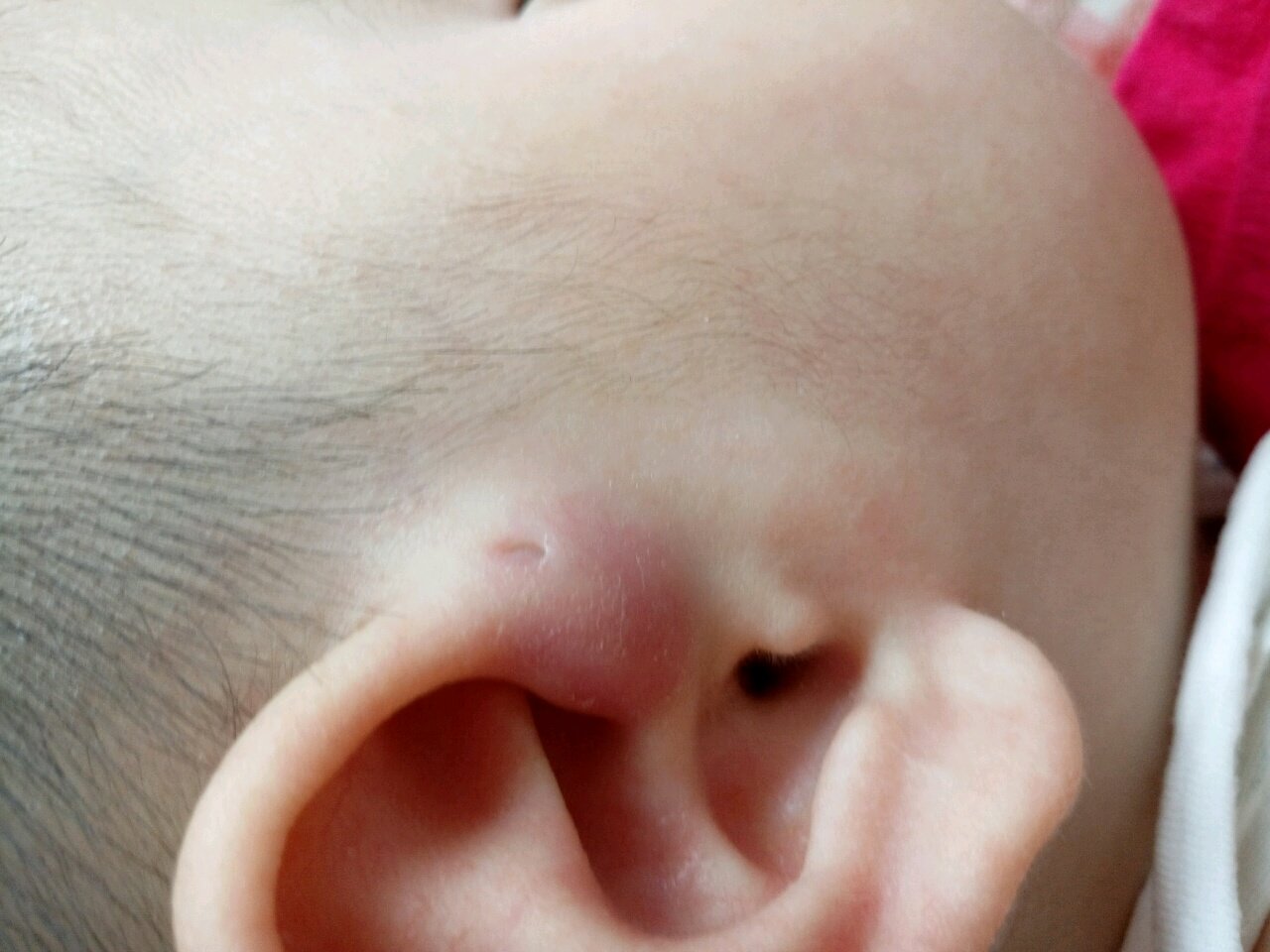 宝宝耳朵上的耳仓发炎了 宝妈有没有知道治好的方法？