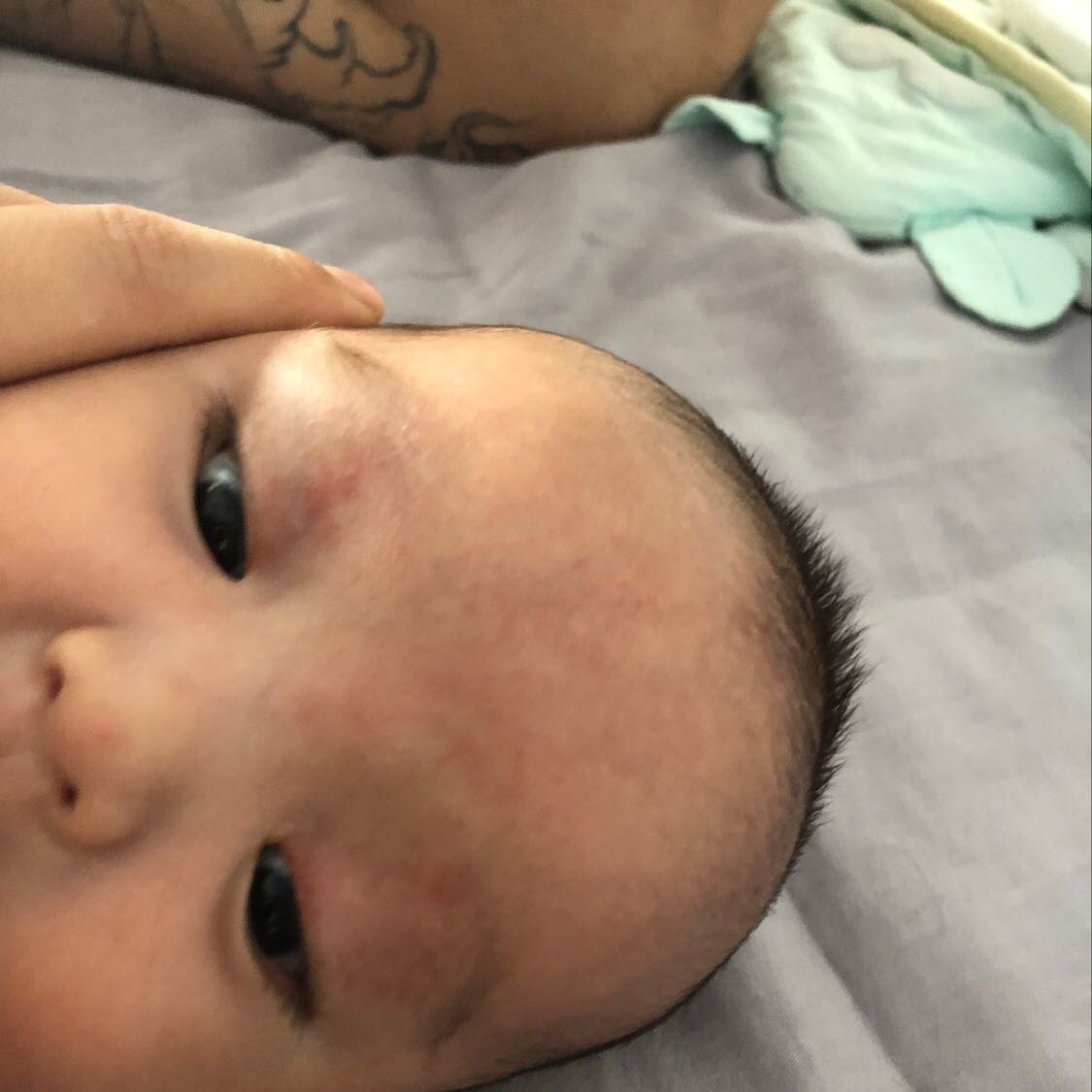 胎记