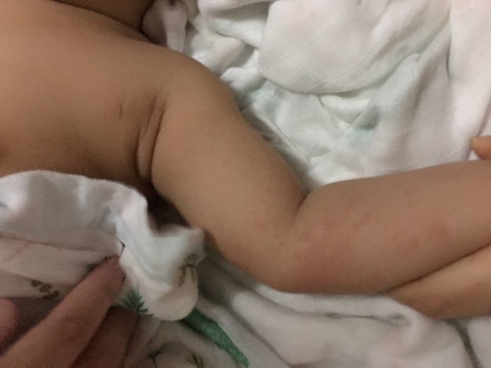 红疹，痱子还是啥，有懂得宝妈吗