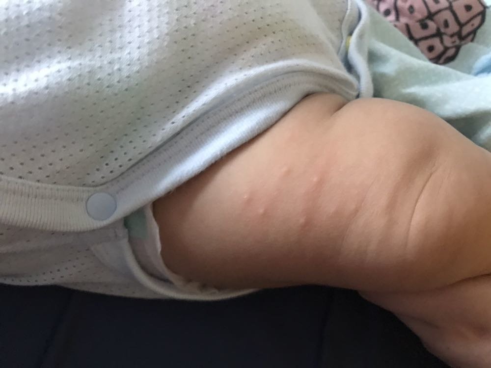 宝宝大腿上长了几个点点，急