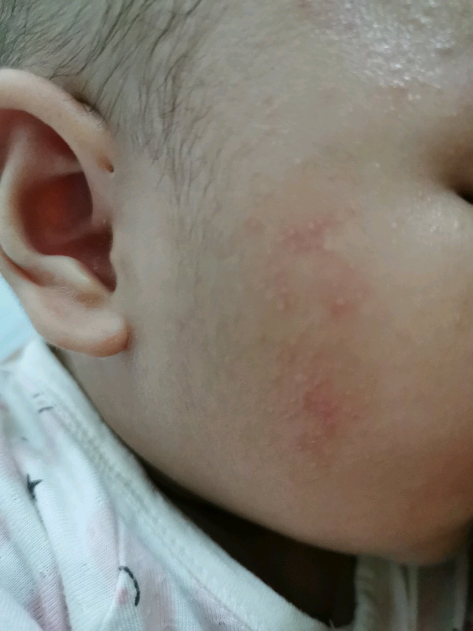 四个月，长湿疹了怎么办