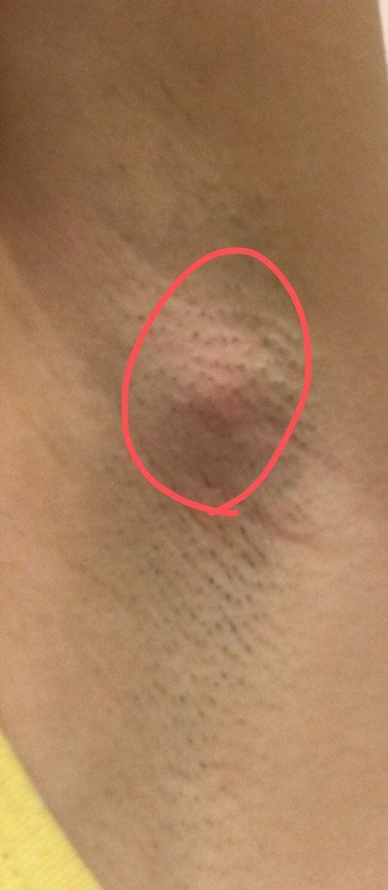 腋下前两天突然发现有块肿起来了，咋回事？