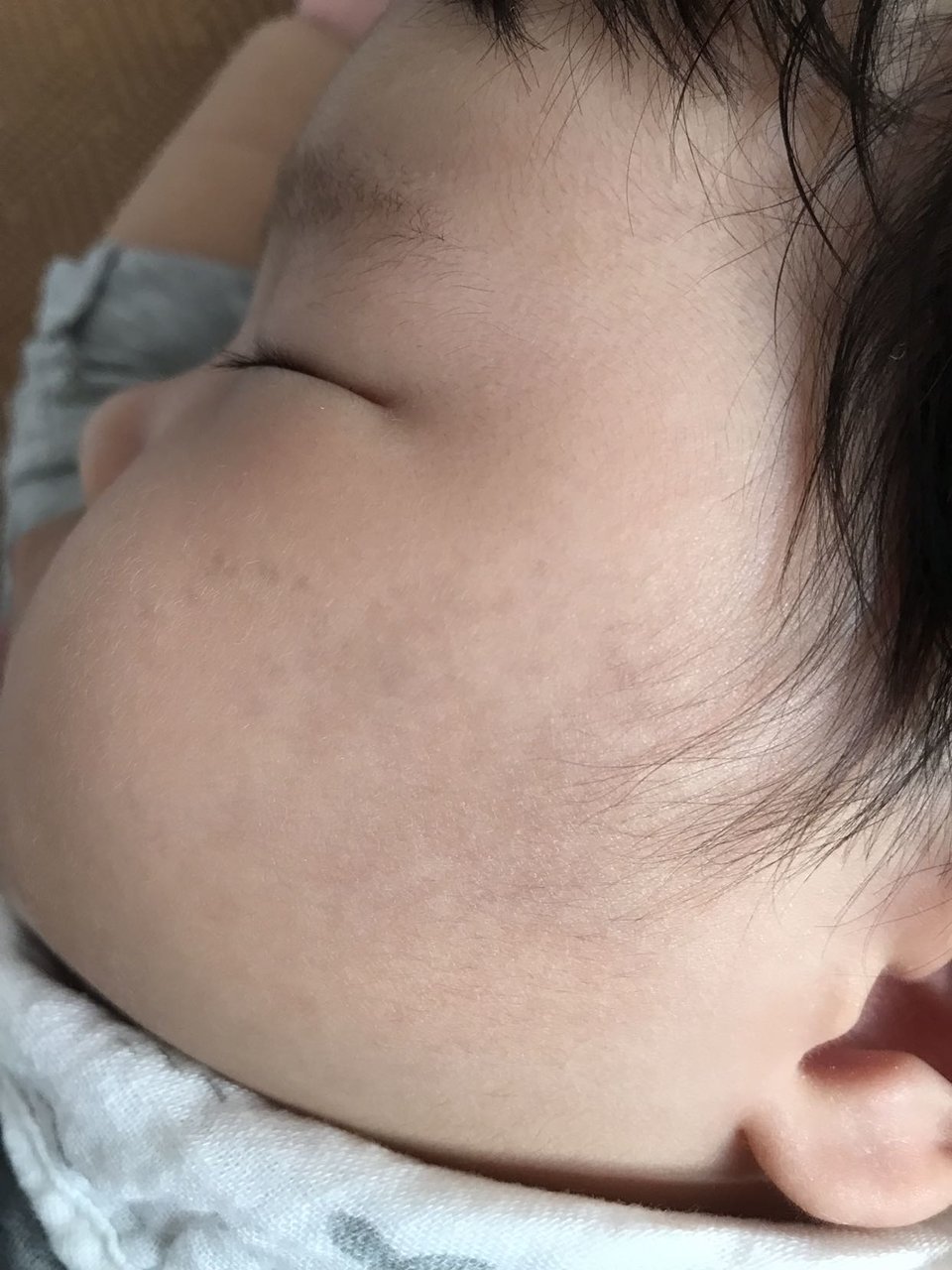五个月宝宝左脸突然有黑块黑点是怎么回事？不是淤青
