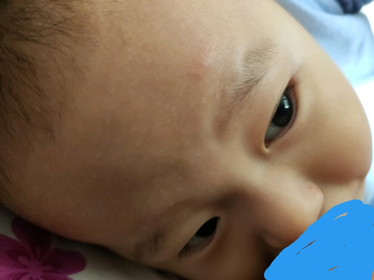 宝宝起了一层小包 也不知道是不是癣