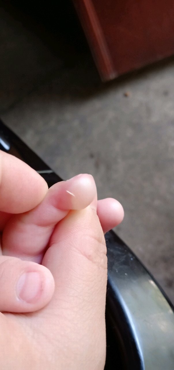 不小心把宝宝给烫伤起泡了