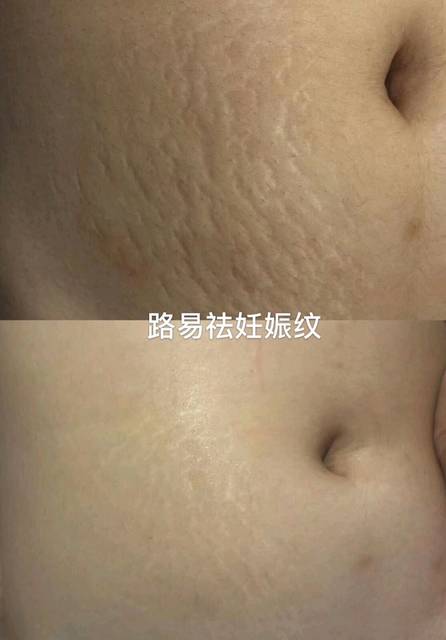 孕期皮肤护理新知：攻克妊娠纹难题