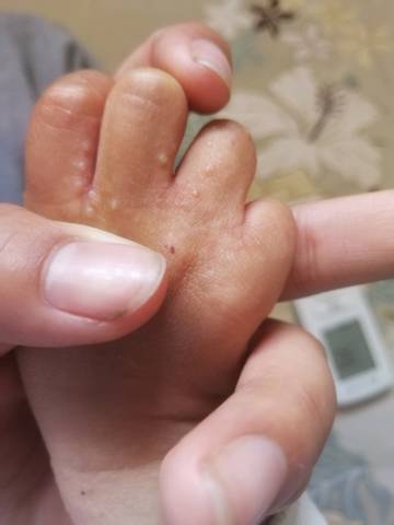 宝宝手上光起这种透明的小水泡,不感冒也不发烧一直抹着药也不下去