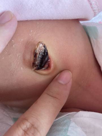 新生儿肚脐眼结痂出血图片