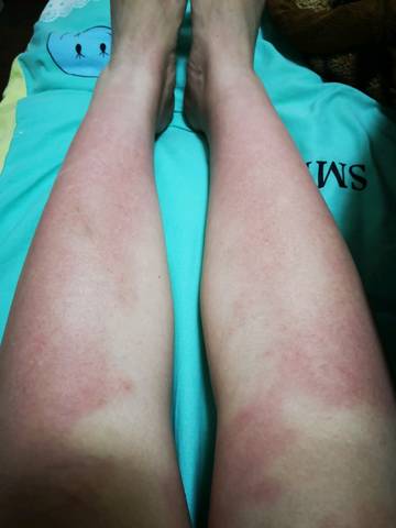 腿部出现一片一片的红像被压一样到底怎么了啊