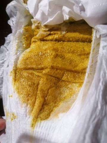 饥饿所致,也可能是腹泻9大便粘液性,鼻涕状并带血,多为痢疾10大便多为