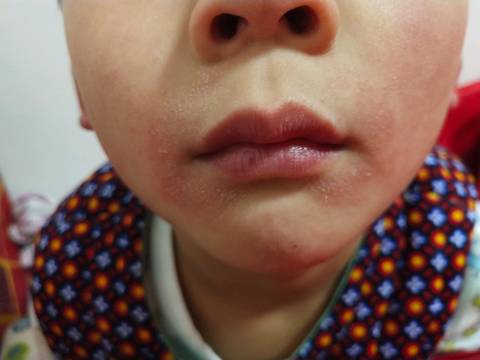 孩子嘴边起红疹子照片图片