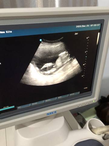 怀孕15周男孩孕彩超图图片
