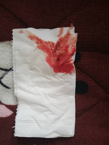 育儿问答 怀孕期 孕期40天有点鲜红的出血,有点担心,去医院检查了孕酮