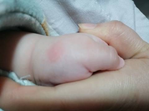 这两天宝宝脸上和手上出现红包,这是什么原因啊