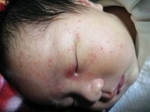 宝宝25天,脸上长很多小痘痘,宝妈们怎么处理,可以用什么药