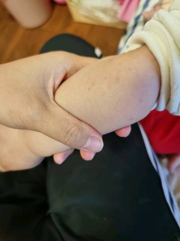 小孩手臂长小红点_育儿问答_宝宝树