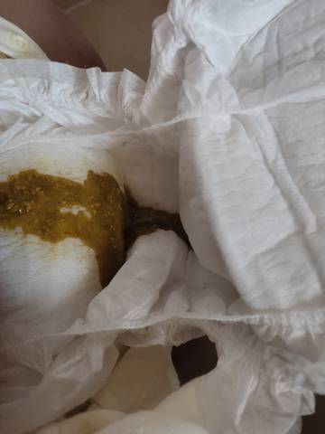 三个月女宝宝拉便便绿色像水状拉得少不多,纯母乳喂养,一天估计要拉三