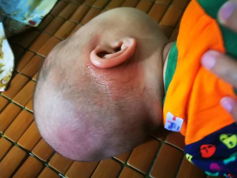 宝贝2个月15天,昨天,突然耳后长了一大片红的,他好像痛一样,动他耳朵