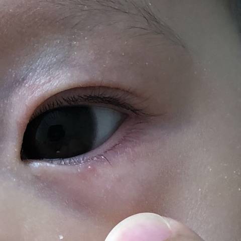 儿童眼睑皮炎症状图片图片