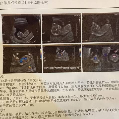 怀孕11周胎儿彩超图图片