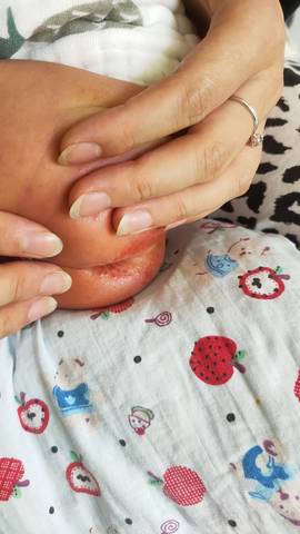 出生十八天的婴儿,红屁股,大家有好用的药推荐吗_育儿问答_宝宝树