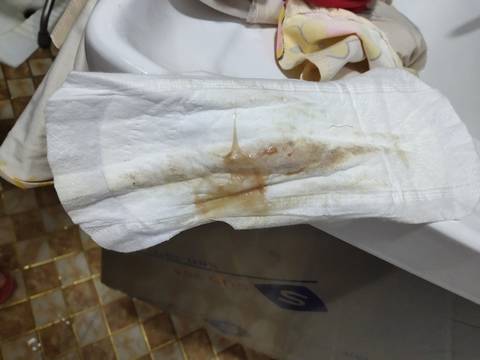 今天卫生巾这样,是怎么回事?