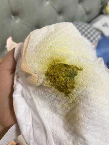 宝宝大便这样的是什么情况