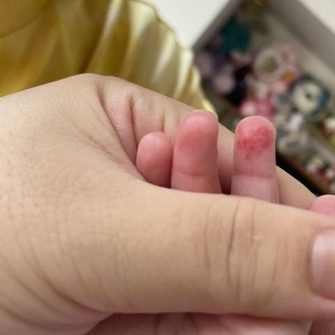 请问宝宝手指的红色斑点一样的东西是什么,10天左右了,还没下去