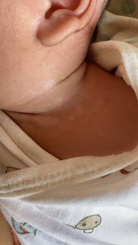 2个月宝宝颈部有白斑图片