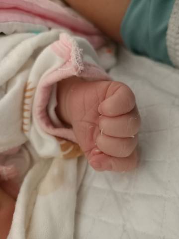 刚出生的宝宝都会蜕皮吗 手上身上都有