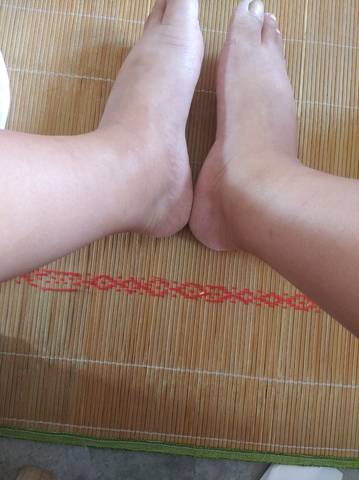 35 5周了,脚肿得像猪蹄一样,走路都走不了,我太难了