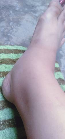 孕期20周了,今天发现腿肿了,什么原因会肿的