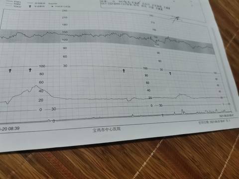 规律宫缩胎心监护图图片